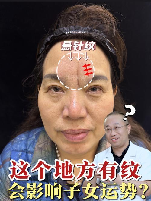 印堂川字紋