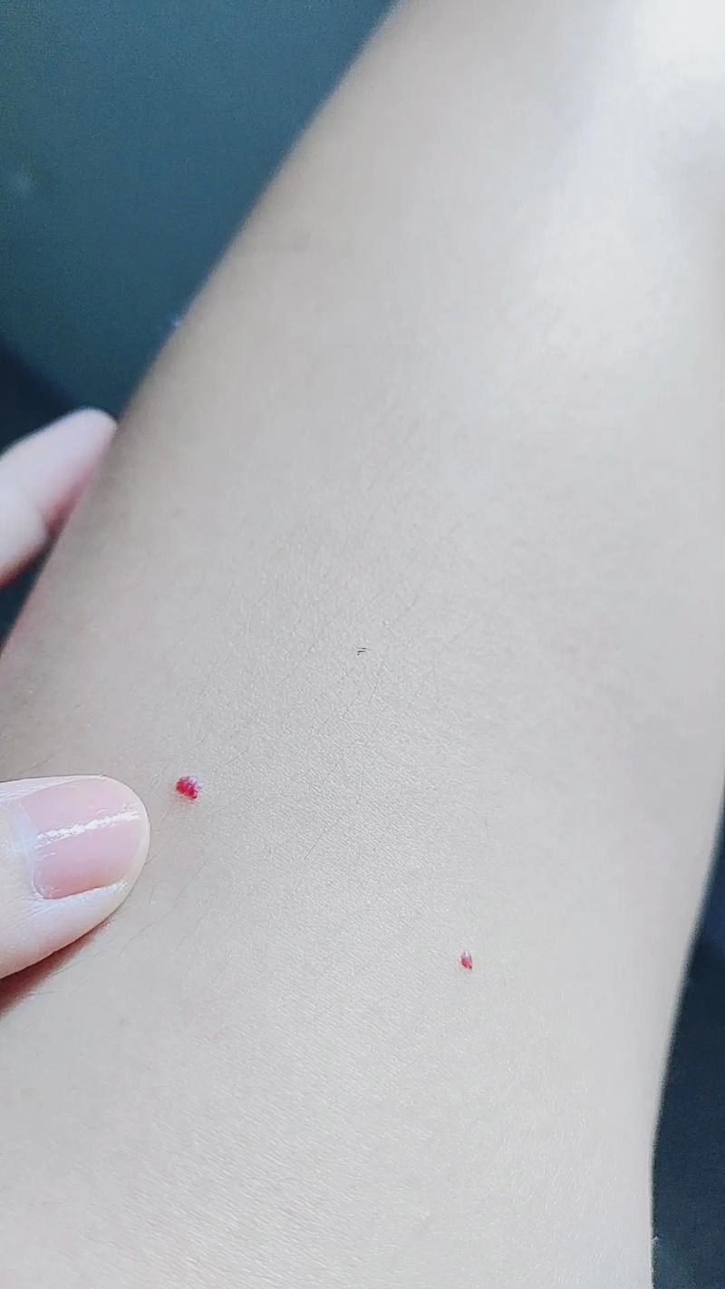 長(zhǎng)紅痣是何事原因