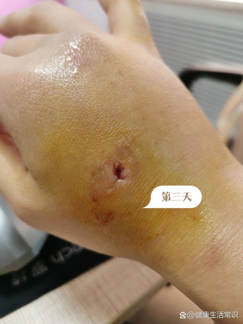 夢(mèng)見(jiàn)狗咬了手出了血