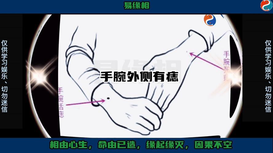 手腕長痣