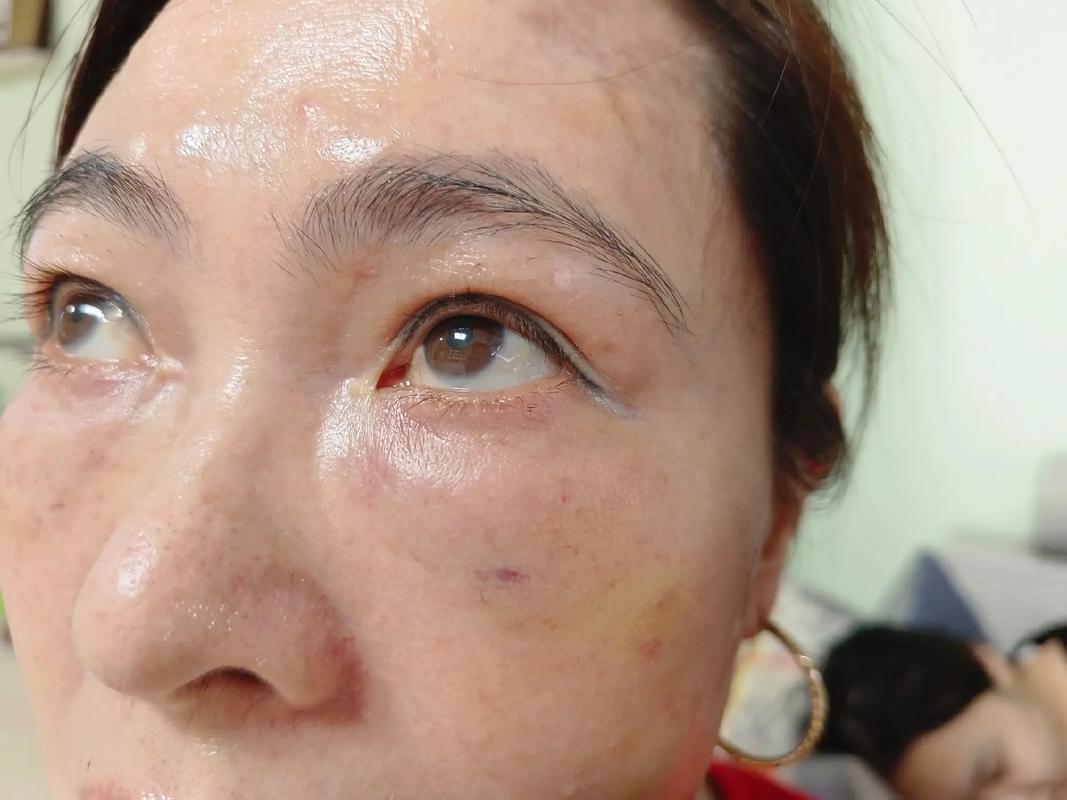 淚溝深的人面相
