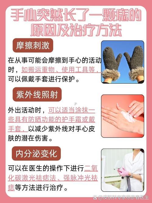 手心有痣代表何事