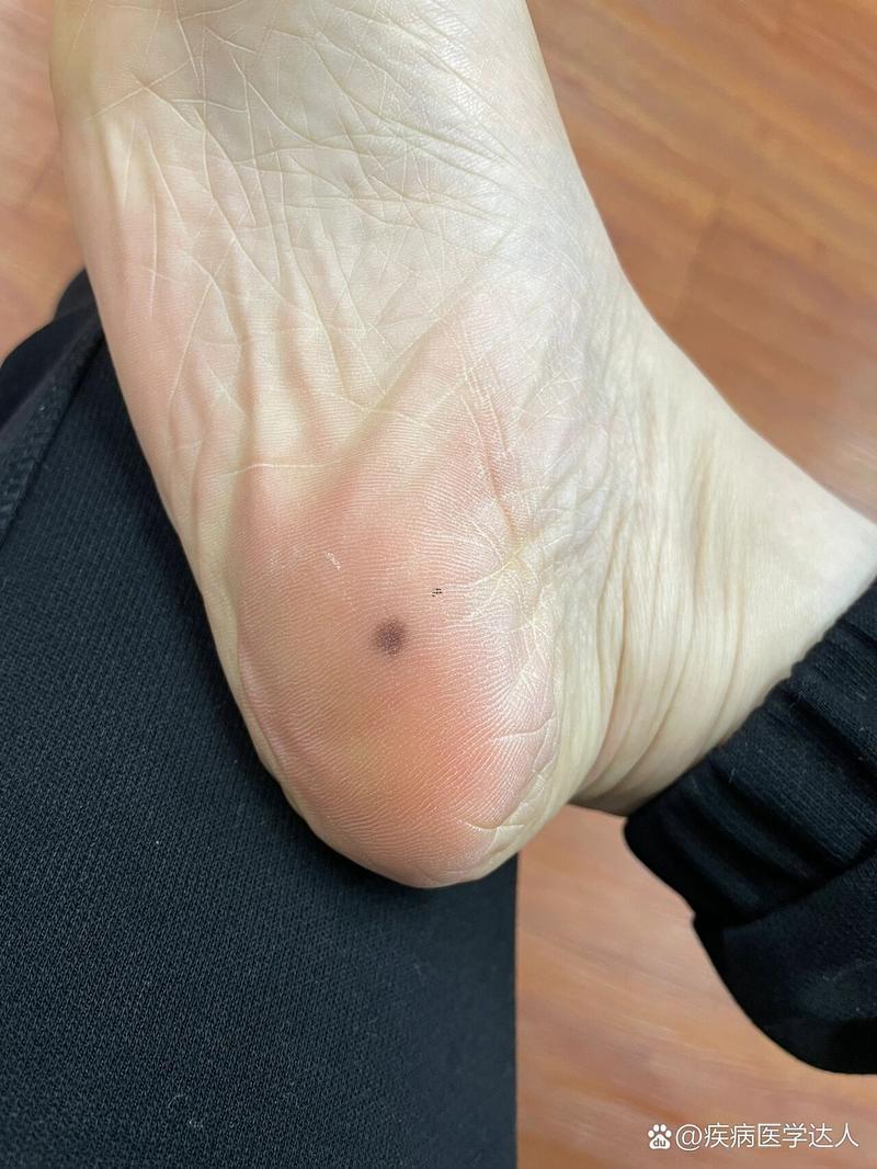 腳后跟有痣的男人