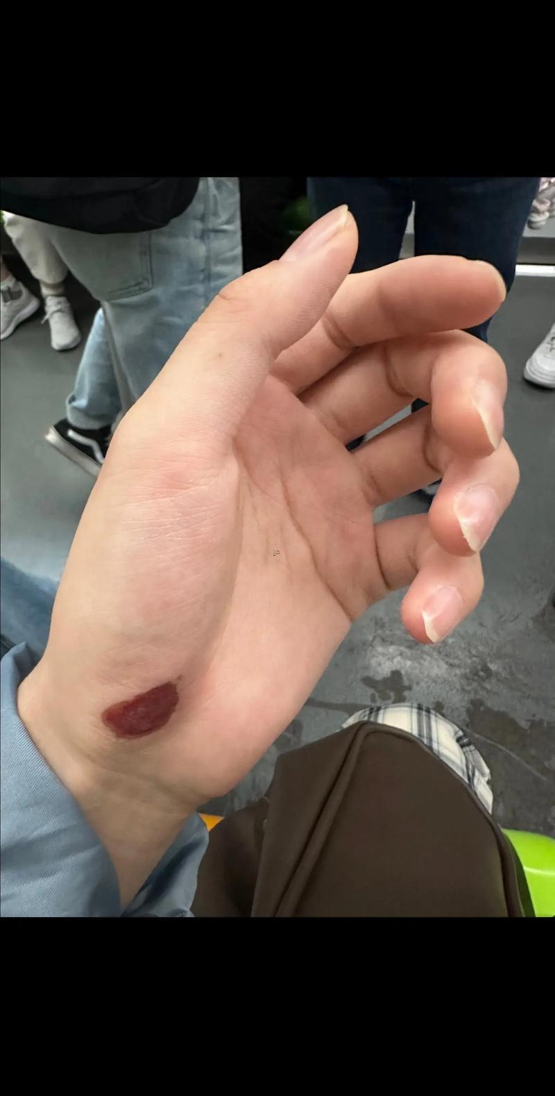手上有痣代表何事