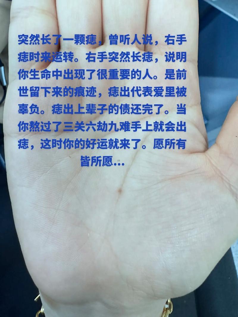 手掌長痣