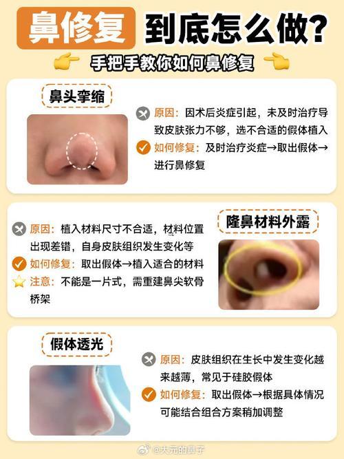 鼻孔外翻