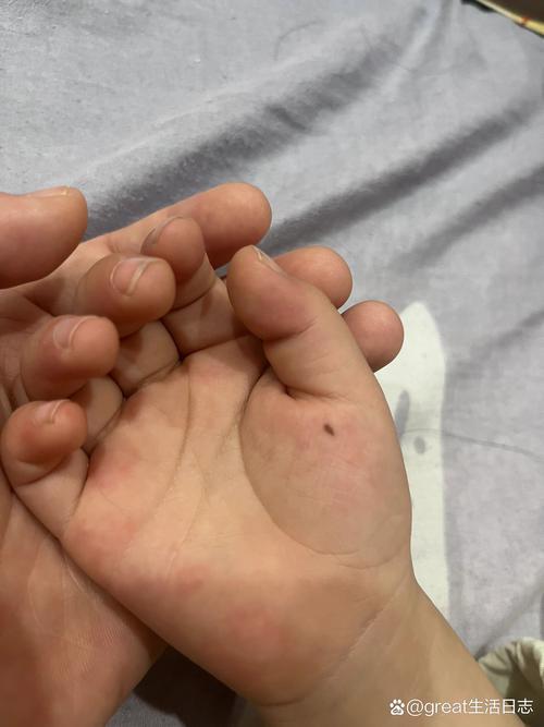 手指長痣