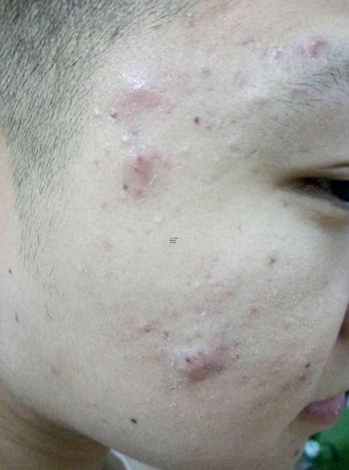 夢見臉上長膿包