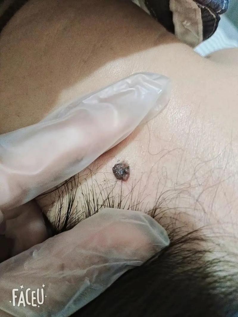 女人面部痣相圖解大全
