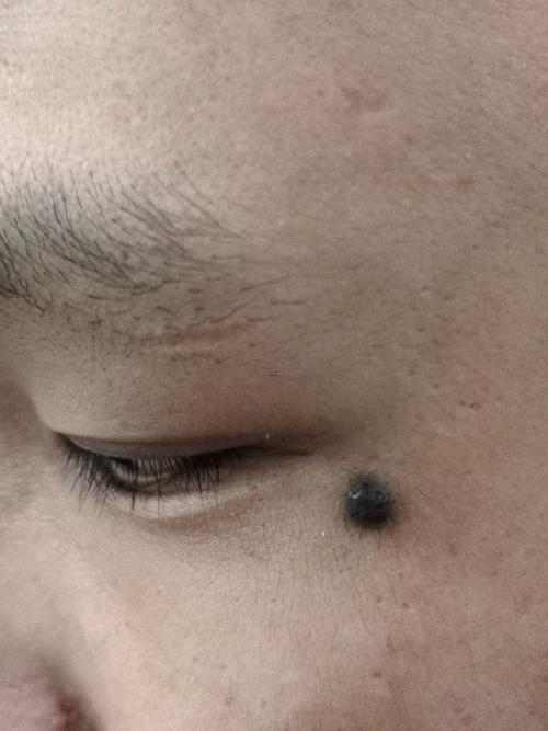 眼角長(zhǎng)痣好不好