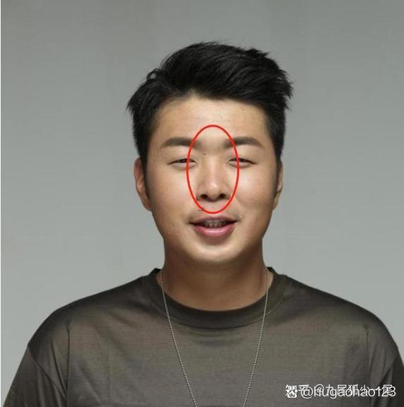 鼻梁塌陷