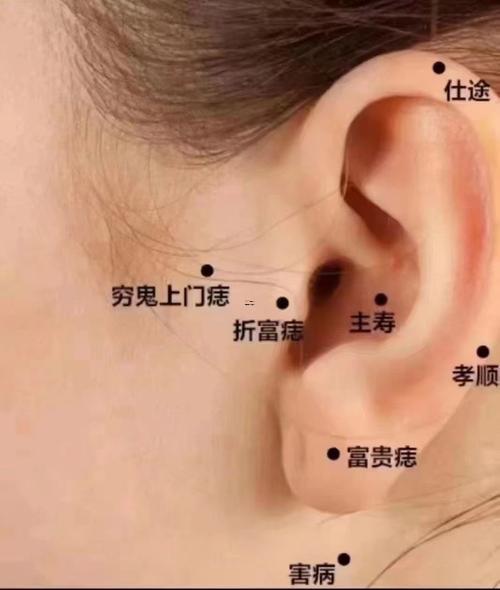 耳屏長痣圖解