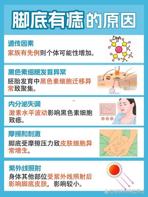 左腳底有痣