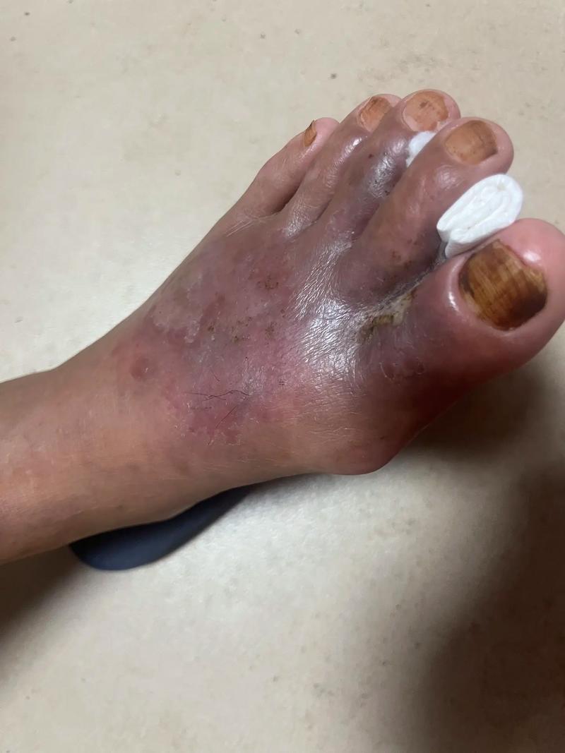 夢(mèng)到被蛇咬腳背