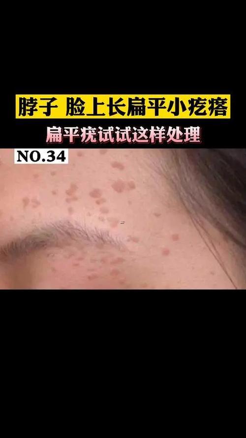 臉上長(zhǎng)痦子
