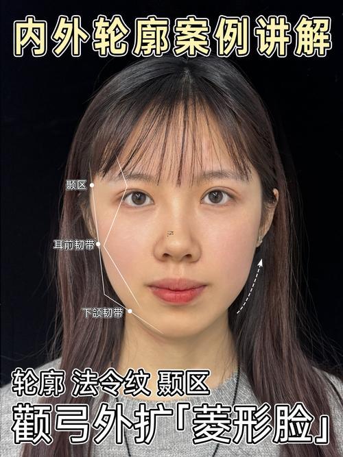 顴骨外擴(kuò)