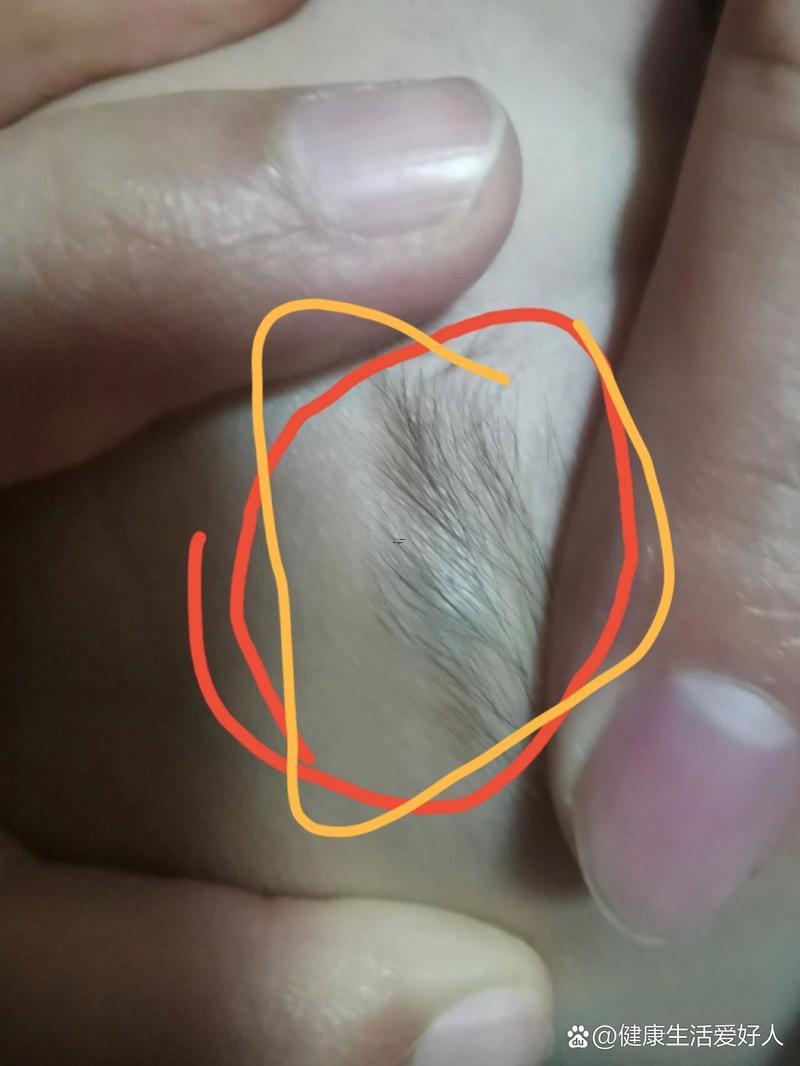 眉尾長痘