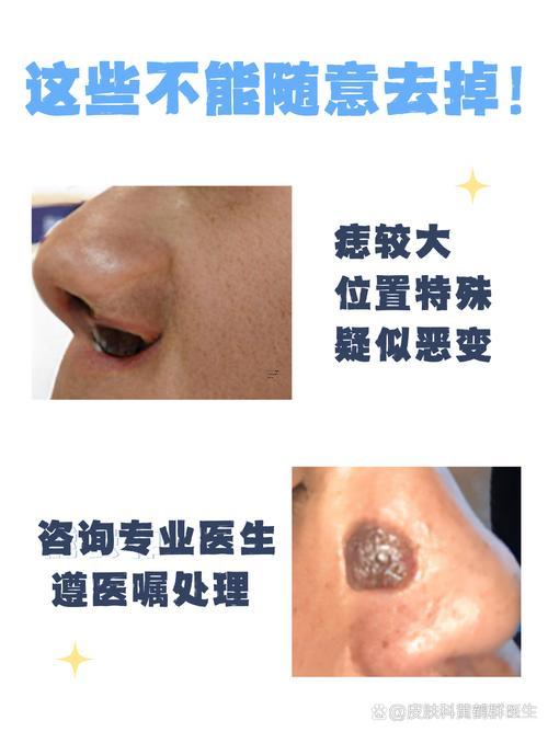 鼻子右邊有痣